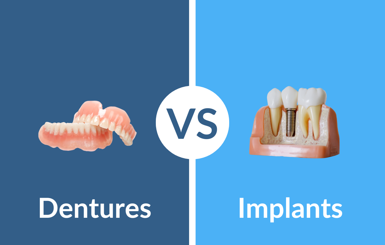 Dentures vs Implants graphic
