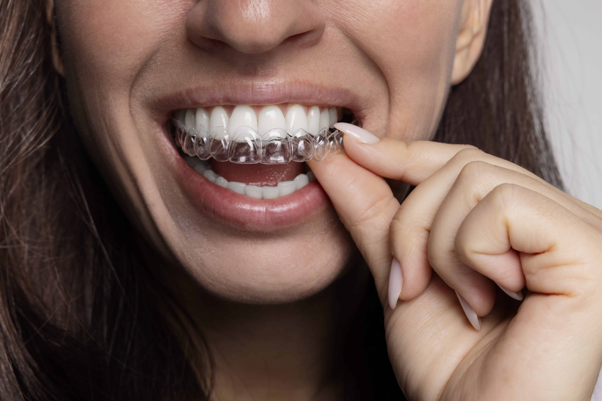 Custom take-home teeth whitening kits Services in Orleans