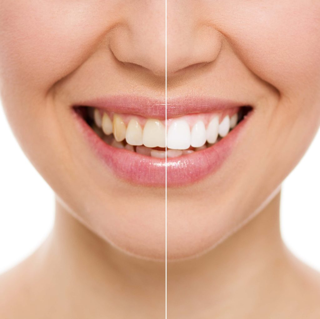 Our professional teeth whitening benefits